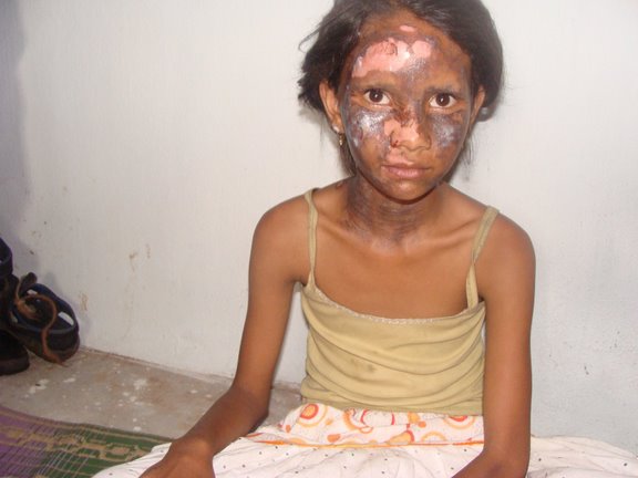 Rapariga ferida em actos de violência anti-cristã na Índia.